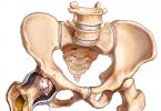 Treatment of osteochondrosis of the hip joint, its symptoms and degrees Symptoms and diagnosis of the disease