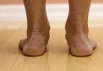 Plano-valgus deformity of the feet in children Valgus clubfoot in children