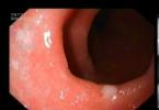 กรดไหลย้อน esophagitis - อาการ สาเหตุ และการรักษา